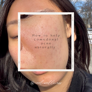 Cleared your Cystic acne but suffering from comedonal acne?